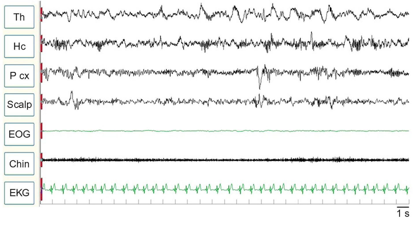 Prof Dr Lino NOBILI: The application of Stereo-EEG to the study of sleep related epilepsies and sleep physiology